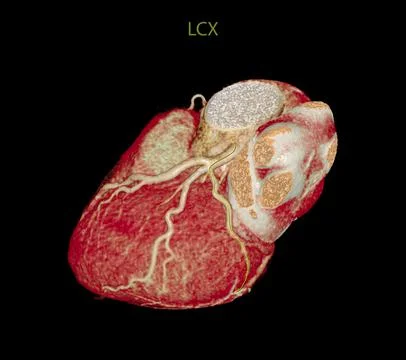 CT Cardiac 3D or CTA coronary artery Stock Illustration