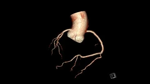 CT Cardiac 3D rendering  or CTA coronary artery for prevention coronary art.. Stock Illustration