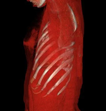 CT Chest 3d rendering . Stock Illustration