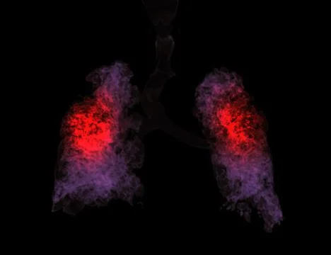 CT Chest 3d rendering showing lung infection from covid-19. Stock Illustration