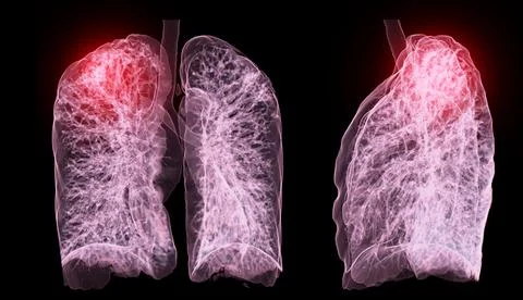 A CT chest 3D scan displaying a lesion at the right upper lobe offers a det.. Stock Illustration