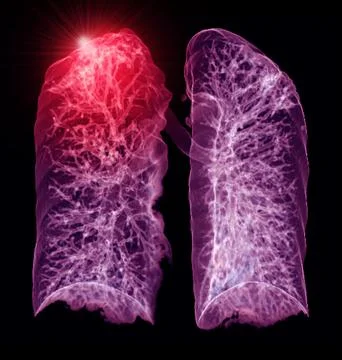 A CT chest 3D scan displaying a lesion at the right upper lobe offers a det.. Stock-Illustration