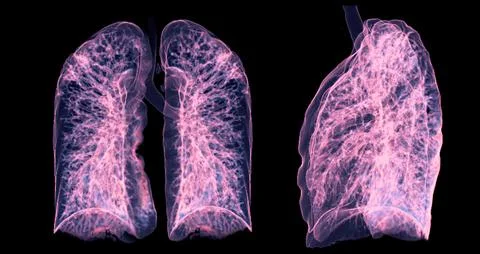 A CT chest 3D scan displaying a lesion at the right upper lobe offers a det.. Stock Illustration