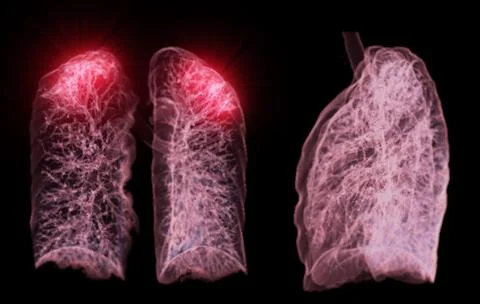 A CT chest 3D scan displaying a lesion at the right upper lobe offers a det.. Stock Illustration