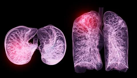 A CT chest 3D scan displaying a lesion at the right upper lobe offers a det.. Stock Illustration