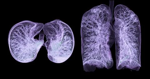 A CT chest 3D scan displaying a lesion at the right upper lobe offers a det.. Stock Illustration