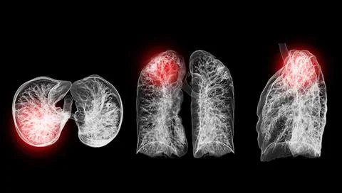 A CT chest 3D scan displaying a lesion at the right upper lobe offers a det.. Stock Illustration