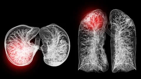 A CT chest 3D scan displaying a lesion at the right upper lobe offers a det.. Stock-Illustration