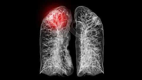 A CT chest 3D scan displaying a lesion at the right upper lobe offers a det.. Stock Illustration