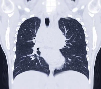 CT Chest Coronal MIP view Stock Illustration