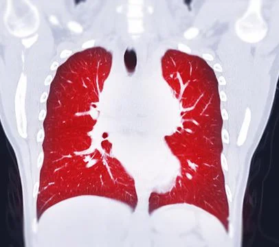 CT Chest Coronal MIP view Stock Illustration
