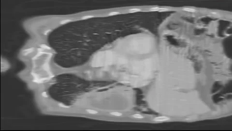 CT chest lung coronal view Male 77year old abscess lung with pneumonia Stock Footage 132926302