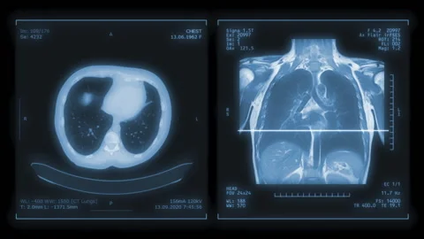 CT Chest or CT Scan of Human Chest Coronal MIP View with Lung filter technique Vidéo 140320197
