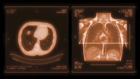 CT Chest or CT Scan of Human Chest Coronal MIP View with Lung filter technique 스톡 동영상 141521901