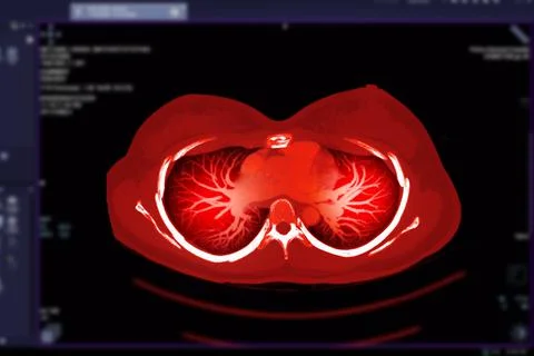 CT Chest or CT Scan of Lung Axial and Coronal  View. Stock Illustration