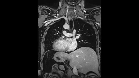 CT Chest or Lung 3D rendering image. diagnosis TB, tuberculosis. Stock Footage 236924160
