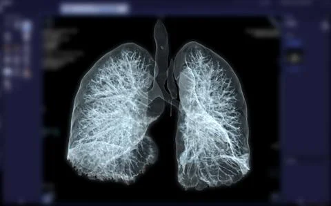 CT Chest or Lung 3D rendering image for diagnosis TB,tuberculosis and covid-1 Stock-Illustration