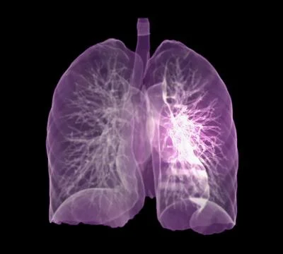 CT Chest or Lung 3D rendering image for diagnosis TB,tuberculosis and covid-1 Stock Illustration