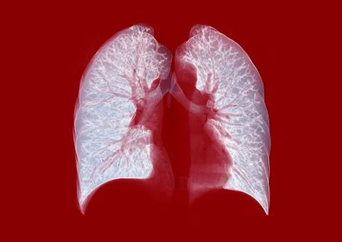 CT Chest or Lung 3D rendering image on red background for diagnosis TB,tuberc Stock Illustration