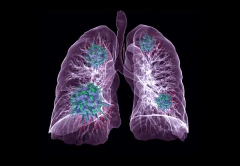 CT Chest or Lung 3D rendering image with virus 3D rendering. Stock Illustration