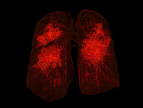 CT Chest or Lung 3D rendering image for diagnosis TB,tuberculosis and covid-1 Stock Illustration