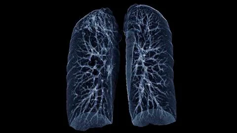 CT Chest or Lung 3d rendering image  showing Trachea and lung in respirator.. Stock Illustration