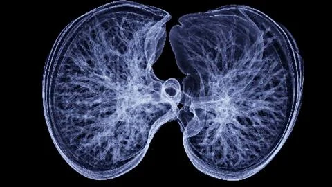 CT Chest or Lung 3d rendering image  showing Trachea and lung in respirator.. Stock-Illustration