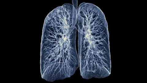 CT Chest or Lung 3d rendering image  showing Trachea and lung in respirator.. Stock Illustration