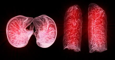 CT Chest or Lung 3d rendering image  showing Trachea and lung in respirator.. Illustrazione stock