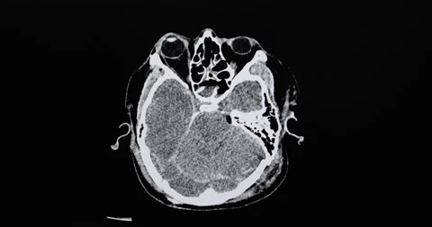 CT cine scan of a patient with falling injury Stock Footage 159698774