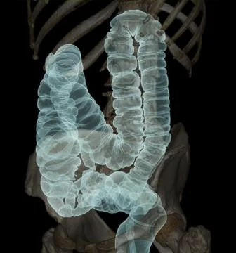 CT colonography  3D Rendering image Stock-Illustration