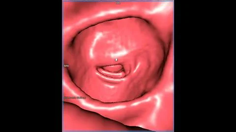 CT colonography  3D rendering image for annual health check-ups to screen f.. Illustrazione stock