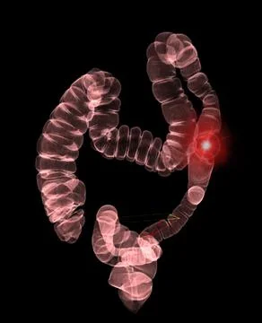 CT colonography . Stock-Illustration