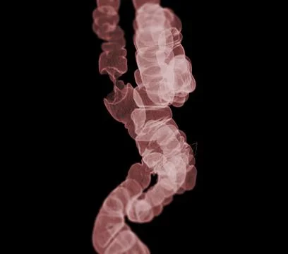 CT colonography . Stock Illustration