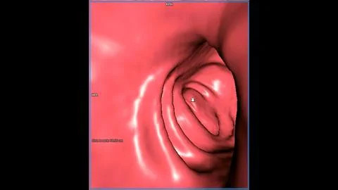 CT colonography , This imaging technique is often employed for colorectal c.. Stock Illustration
