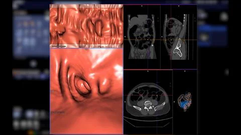 CT colonography , This imaging technique is often employed for colorectal c.. Stock Illustration