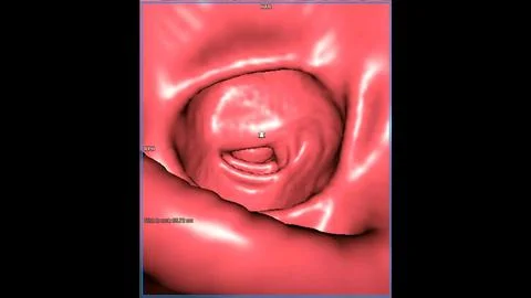 CT colonography , This imaging technique is often employed for colorectal c.. Stock-Illustration