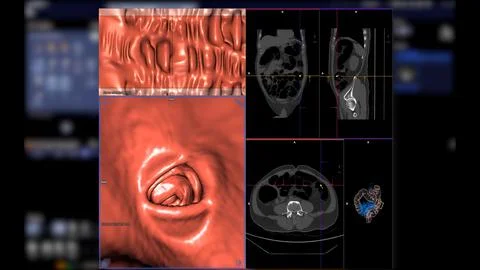 CT colonography , This imaging technique is often employed for colorectal c.. Illustrazione stock