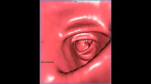 CT colonography , This imaging technique is often employed for colorectal c.. Stock-Illustration