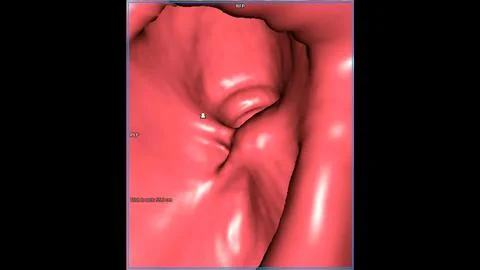 CT colonography , This imaging technique is often employed for colorectal c.. Stock Illustration