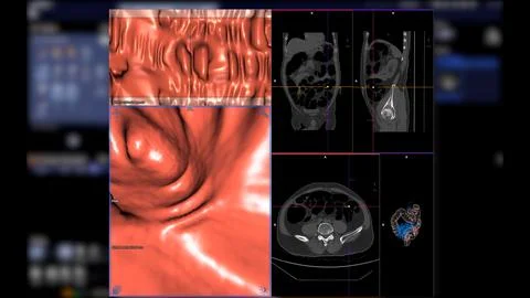 CT colonography , This imaging technique is often employed for colorectal c.. Stock-Illustration