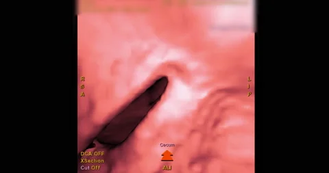 CT colonography or CT Scan of large intestine 3D rendering . Stock Footage 206997897