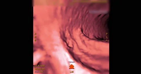 CT colonography or CT Scan of large intestine 3D rendering . Stock Footage 206998792