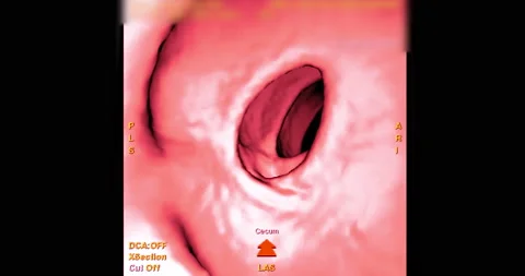 CT colonography or CT Scan of large intestine 3D rendering . Stock Footage 206998884