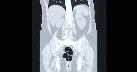 CT colonography or CT Scan of large intestine 3D rendering . Stock Footage 207000075