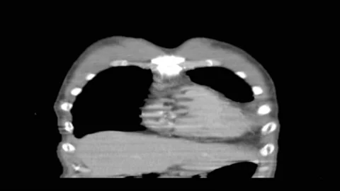 CT Coronal view scan body with contrast Abdominal aortic aneurysm Stock Footage 132528036