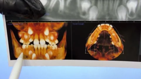 CT image of the teeth of a 9-year-old child, with baby teeth Stock Footage 279576666