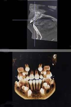CT image of the teeth of a 9-year-old child, with baby teeth, in different pr Stock Photos