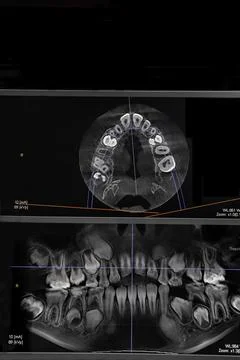 CT image of the teeth of a 9-year-old child, with baby teeth, in different .. Stock Photos
