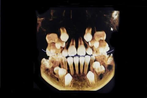 CT image of the teeth of a 9-year-old child, with baby teeth, in different pr Stock Photos